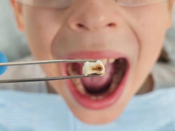 Best Emergency Dental Care for Broken or Chipped Teeth in Danbury, CT