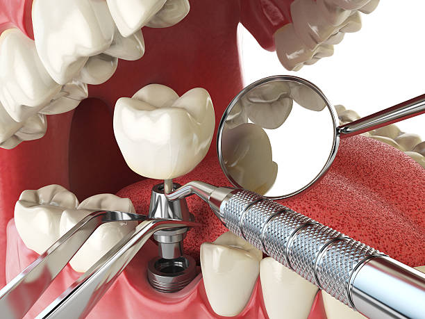 Best Emergency Root Canal Treatment in Danbury, CT